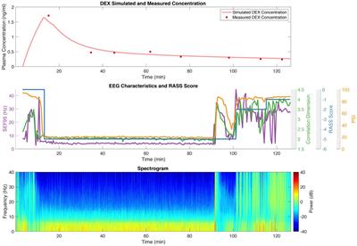 EEG response of dexmedetomidine during drug induced sleep endoscopy